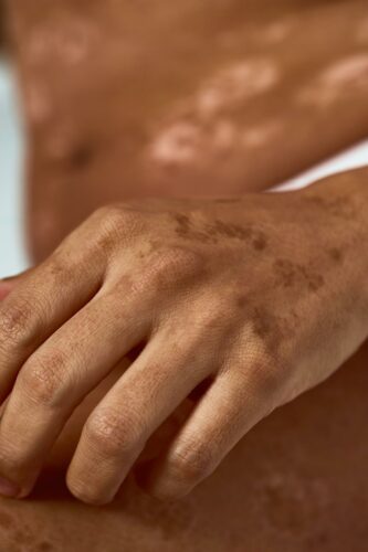 taches soleil beau mat scaled