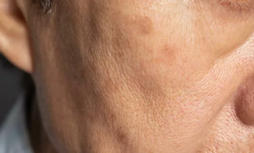 close up peau inducteurs de collagene